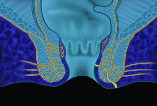 Fistula Anal